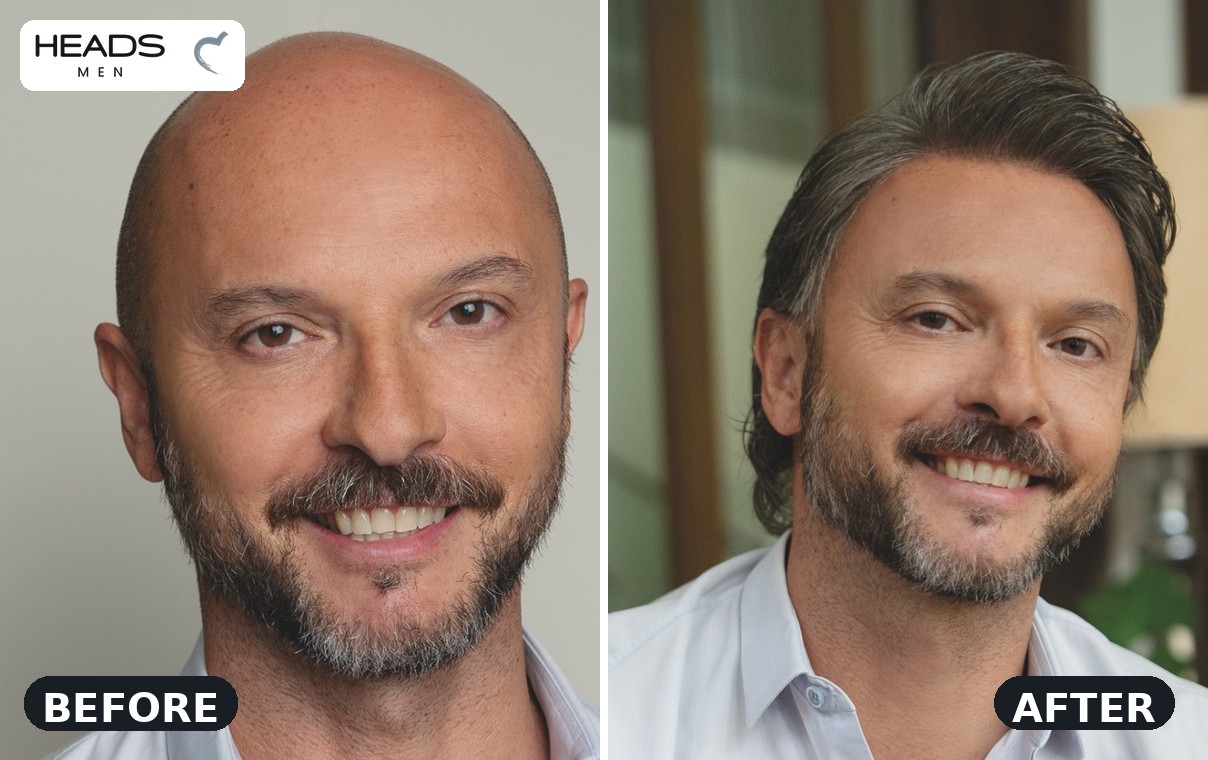 HEADS men's hair system before and after — bald before, full hair after