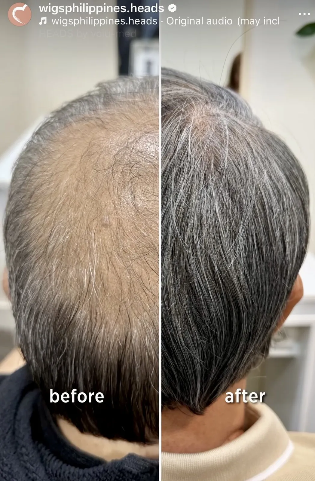 Non-surgical hair replacement before and after — thinning before, full hair after