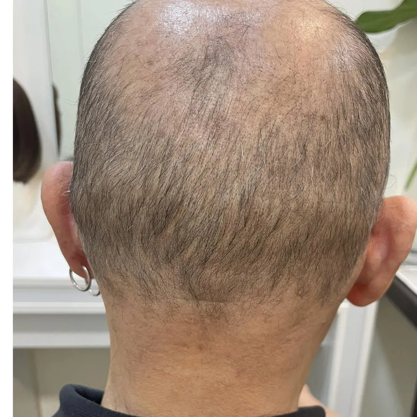 Real HEADS client — bald back of head before his hair system