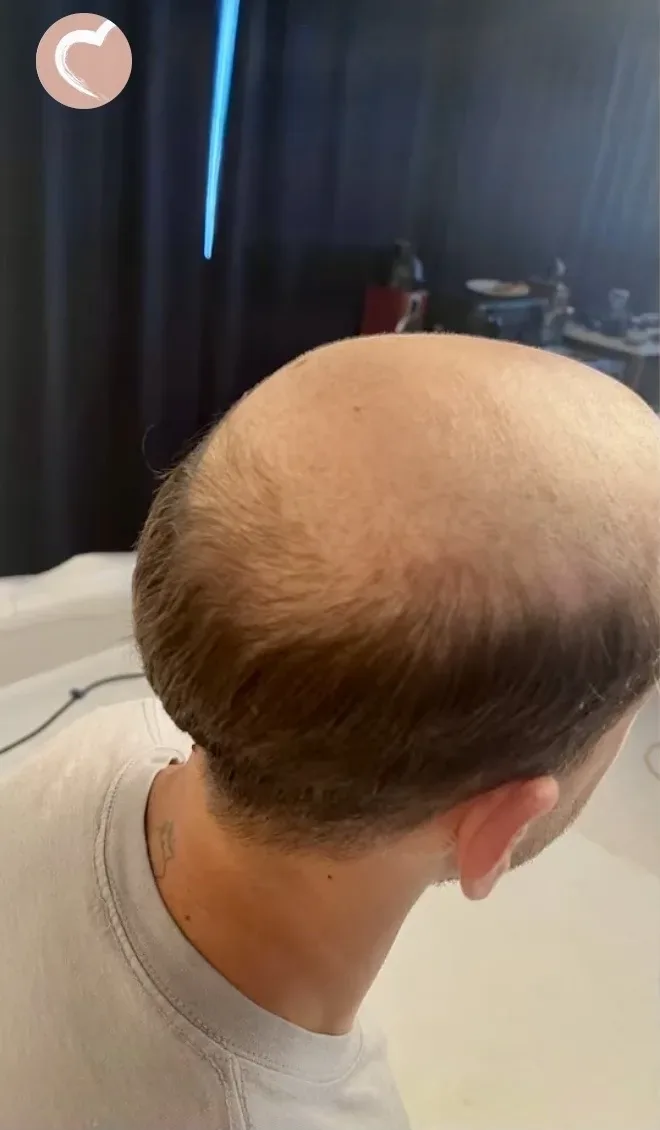 Real HEADS client — bald crown before his hair system, back view