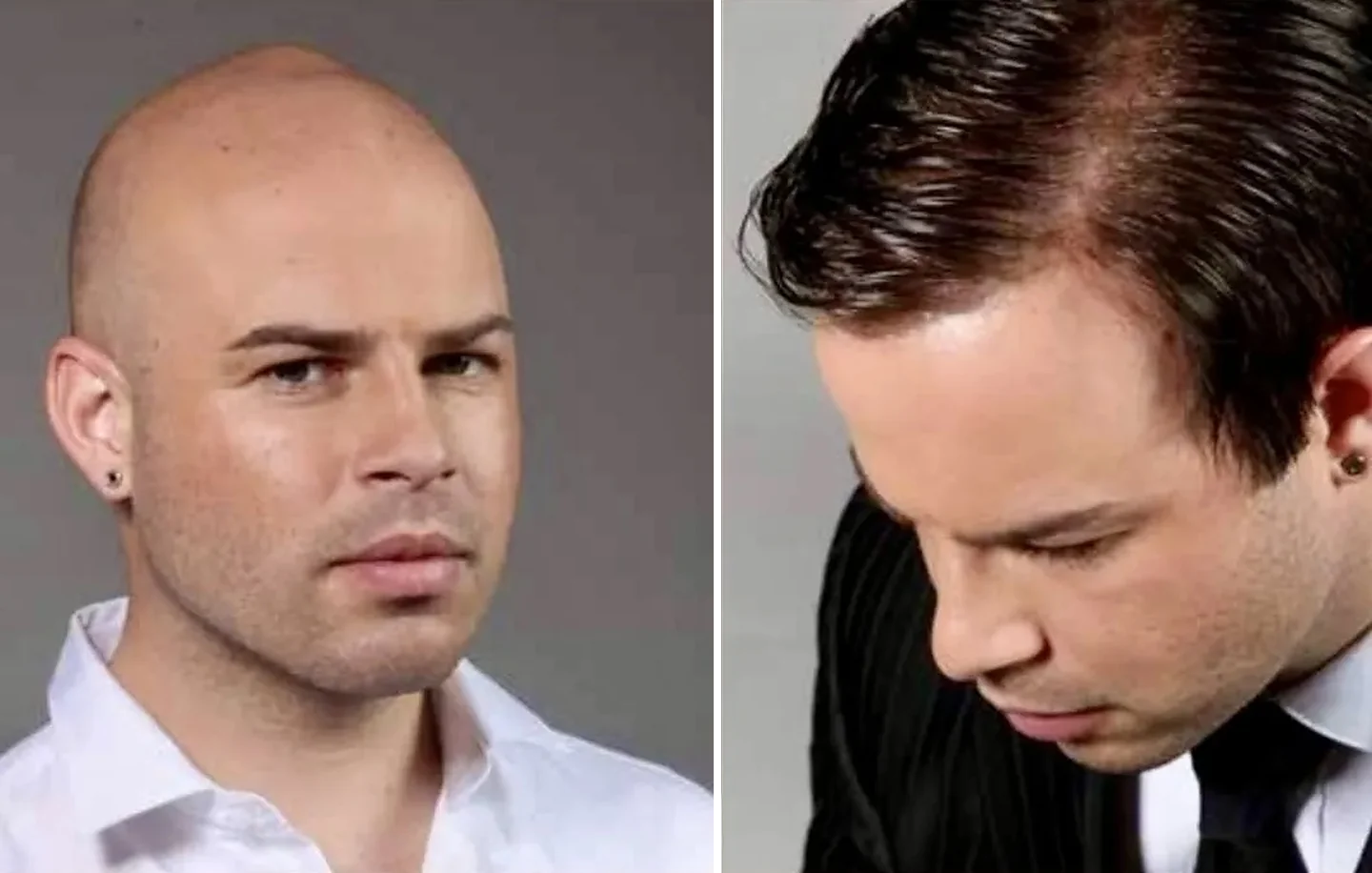 Real HEADS client in Makati — bald before, full natural hair after a custom hair system