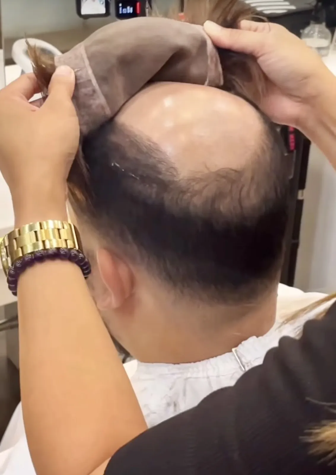 Real HEADS client — lace hair system being applied to a bald crown