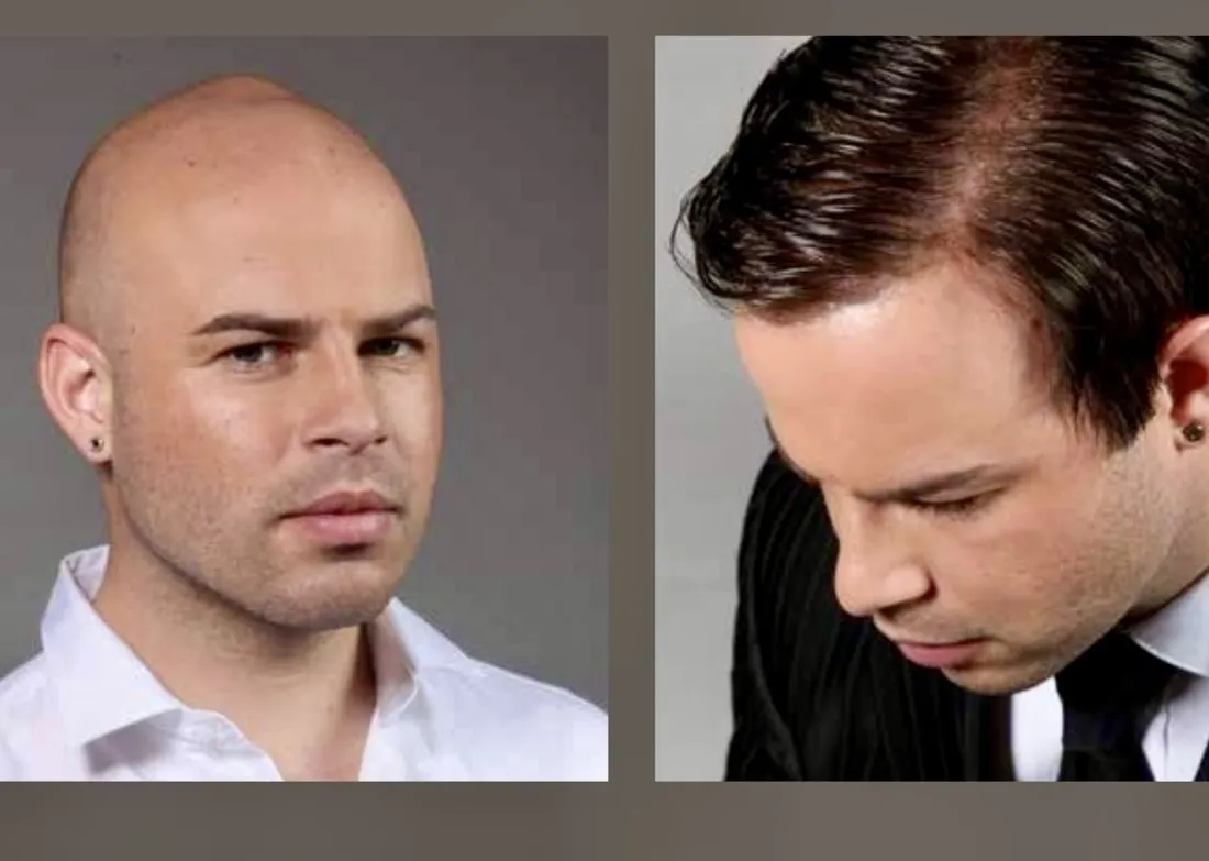 Real HEADS client in Makati — bald before, full natural hair after a custom hair system