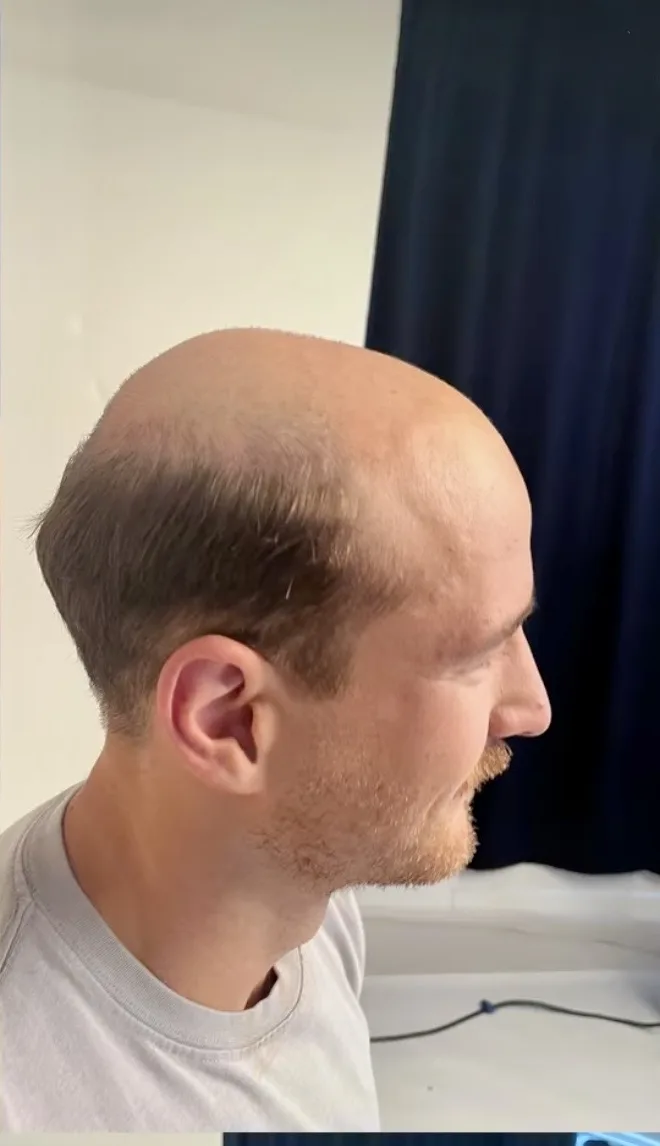 Real HEADS client — receding, thinning hair before, profile view