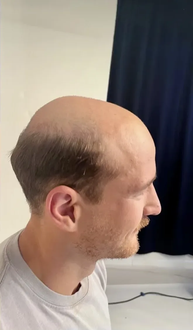 Real HEADS client — receding, thinning hair before, profile view