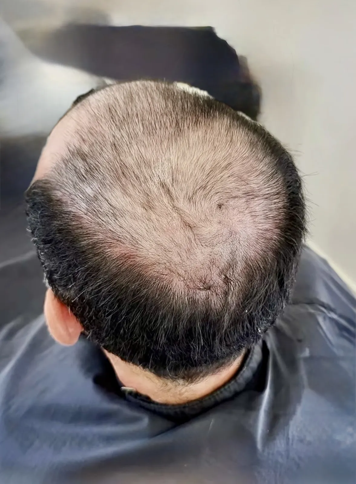 Real HEADS client — advanced thinning at the crown before his hair system, top view