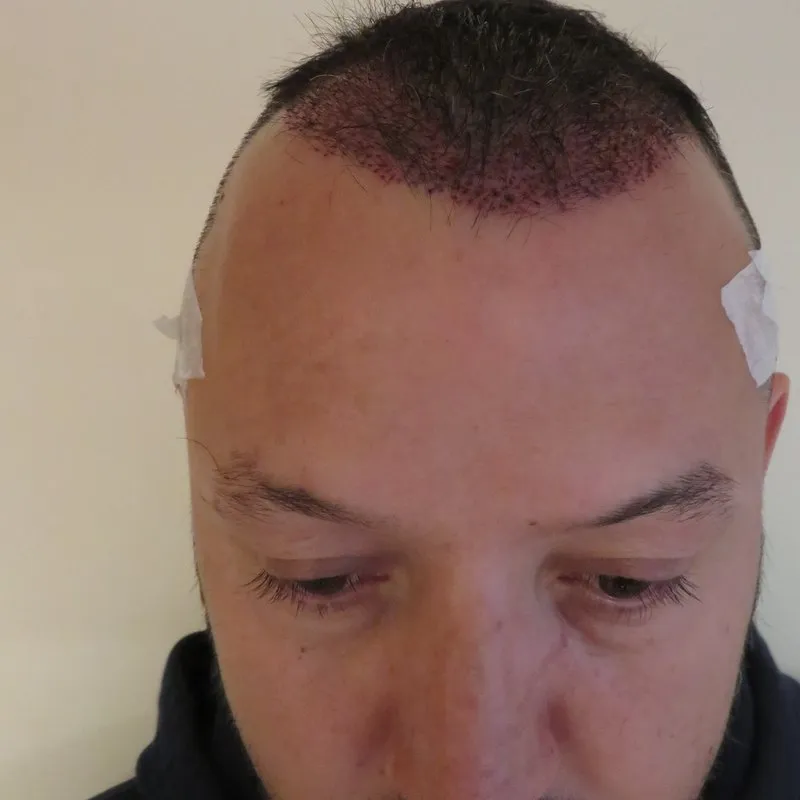 Recipient area healing after a hair transplant procedure