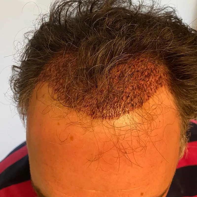 Scalp immediately after a hair transplant, showing freshly placed grafts and skin irritation
