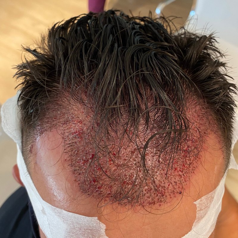 Transplanted hairline on day two, grafts and redness visible during healing