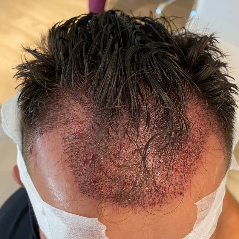 Transplanted hairline on day two, grafts and redness visible during healing